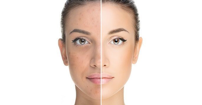 How to do an Acne Facial