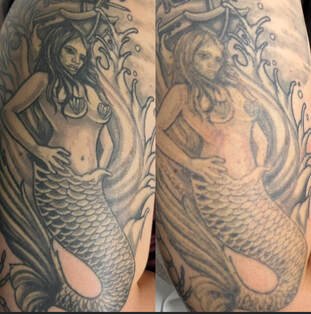 Laser Tattoo Removal in Pleasant V…