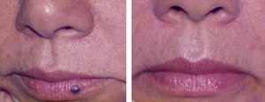 skin tag removal ogden