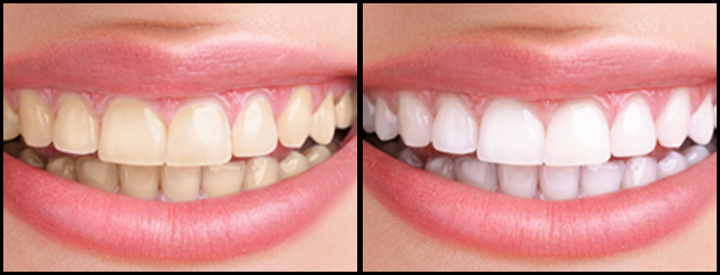 teeth whitening ogden orig