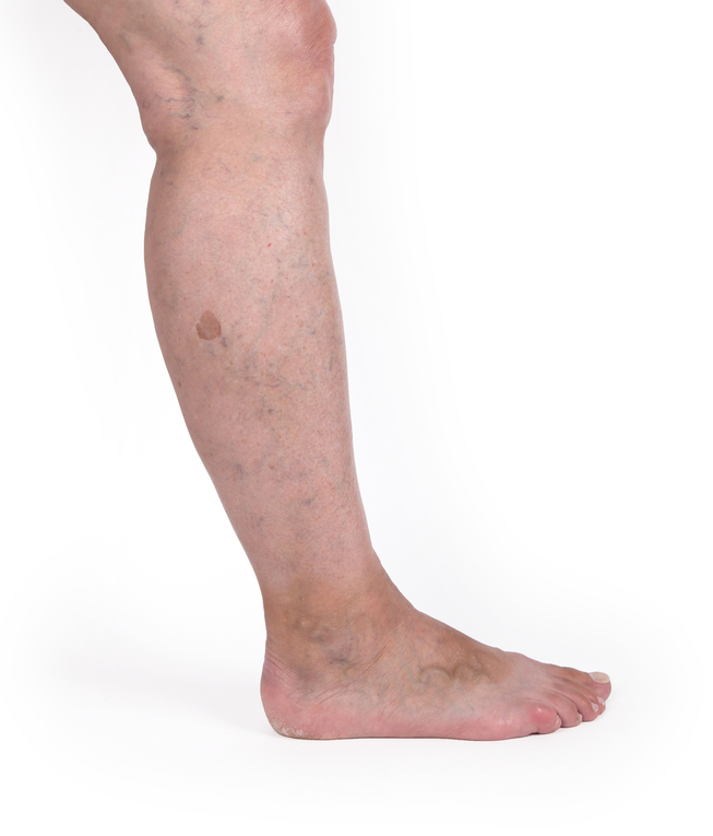 varicose veins laser therapy spider vein treatment orig