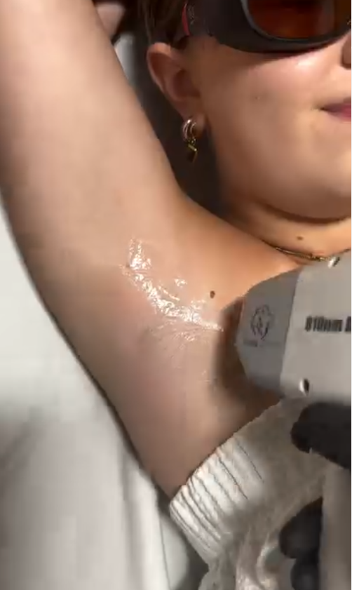 Benefits of Laser Hair Removal