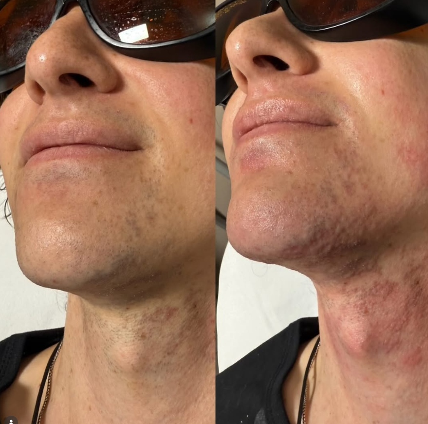 Laser Hair Removal Near Me Pleasant View for Face & Body