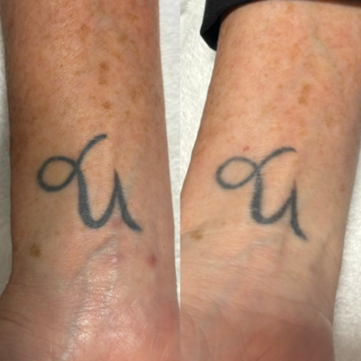 Laser tattoo removal Pleasant View UT