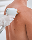 laser hair removal Ogden, laser tattoo removal Ogden, hyperpigmentation treatment Ogden, acne scar treatment Ogden, Ogden Skin Care laser, laser skin resurfacing Ogden, laser facial Ogden